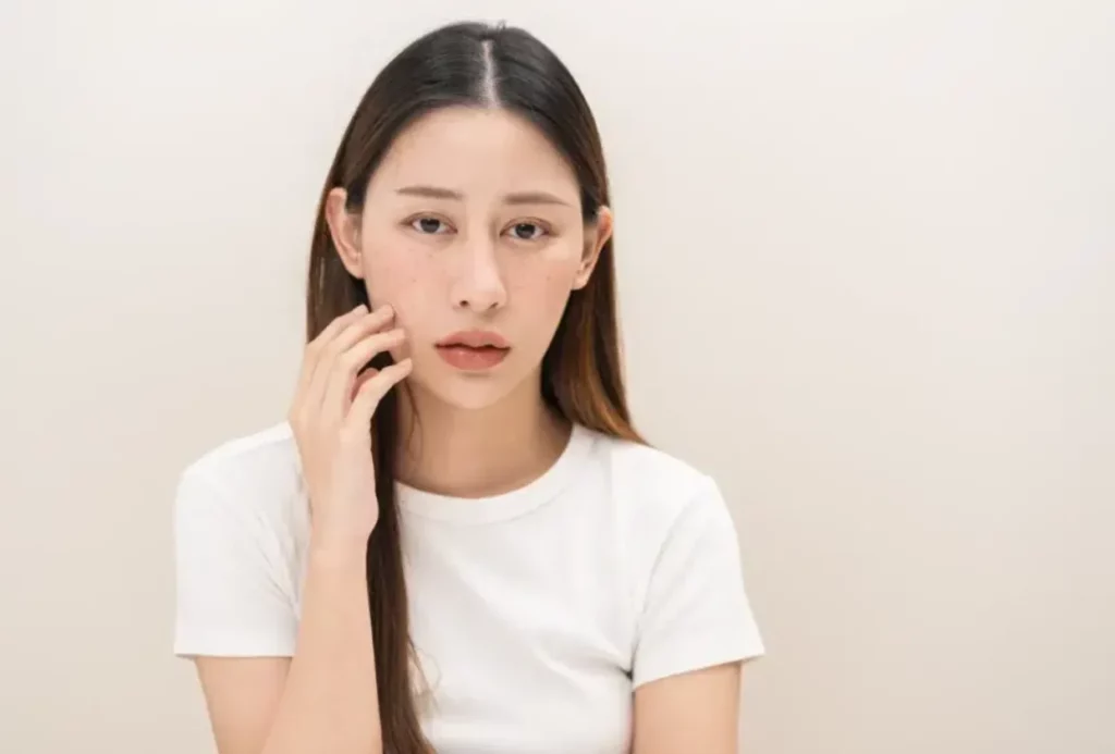 Melasma Management in Singapore: How Sylfirm X Targets Pigment and Blood Vessels Together Melasma Management in Singapore How Sylfirm X Targets Pigment and Blood Vessels Together