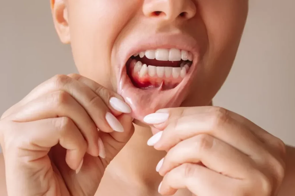 5 Common Myths About Gum Disease Debunked