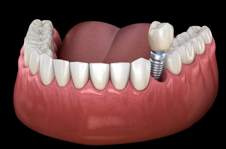 Living with Dental Implants: A Modern Solution for Comfort, Confidence, and Function Living with Dental Implants A Modern Solution for Comfort, Confidence, and Function