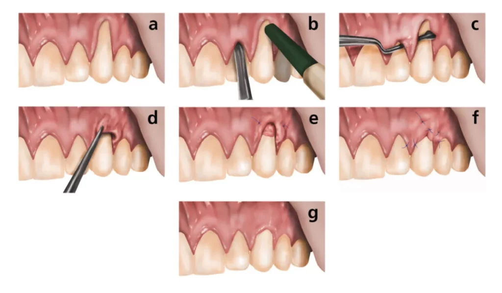 4 Types Of Periodontal Treatments Explained 4 Types Of Periodontal Treatments Explained