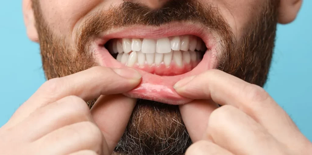 How to Get a Bone Spur Out of Gums
