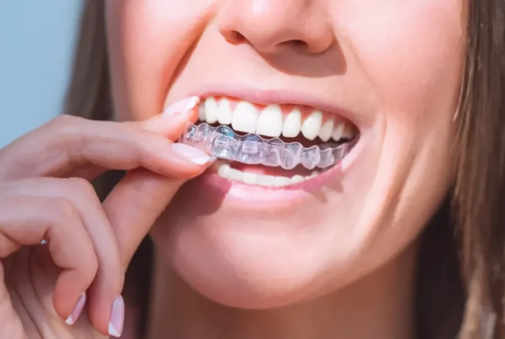 The Importance Of Consistency When Wearing Clear Aligners The Importance Of Consistency When Wearing Clear Aligners